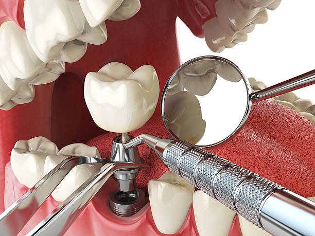 Best Emergency Root Canal Treatment in Palouse, WA